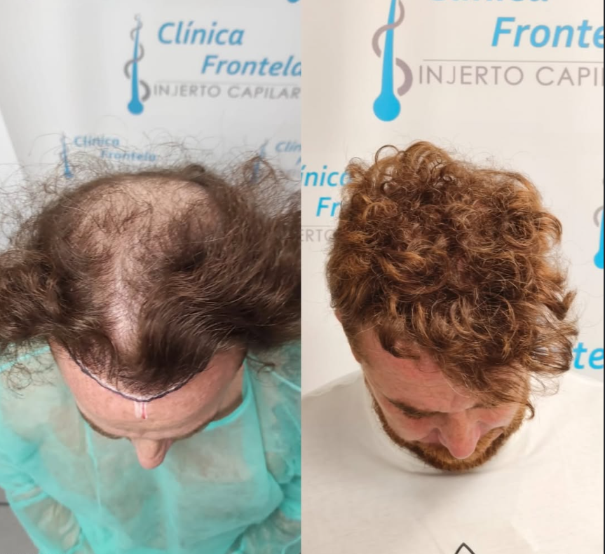 Antes y después de un injerto de pelo con resultado natural y alta densidad capilar.