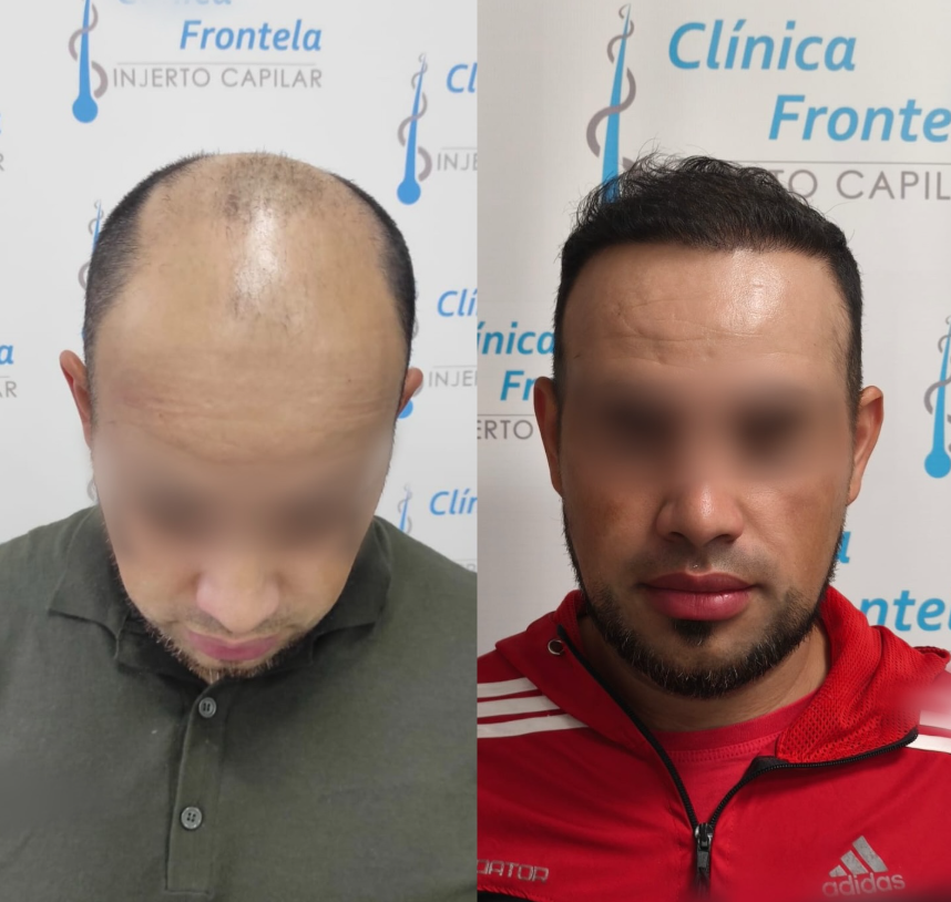 Resultados de injerto capilar en paciente tratado con técnica FUE GOLD.