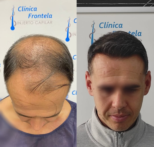 Antes y después de un trasplante capilar realizado en Clínica Frontela.