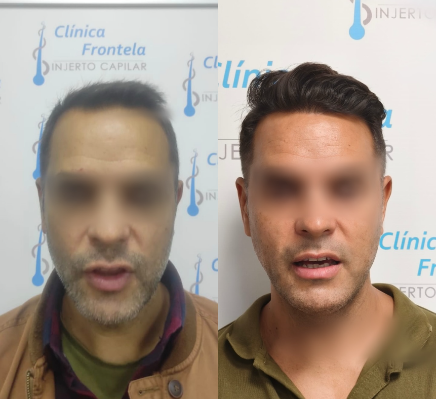 Resultado de injerto capilar con técnica FUE GOLD en paciente de Clínica Frontela