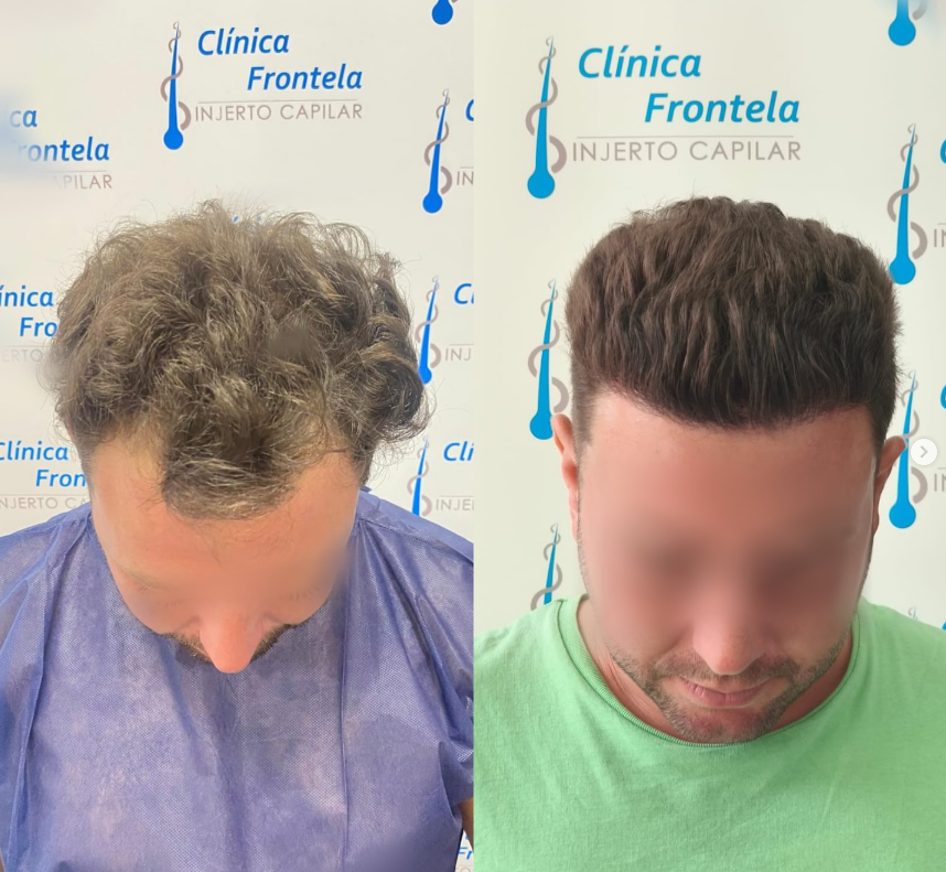 Caso real de injerto capilar con recuperación de la línea frontal del cabello.
