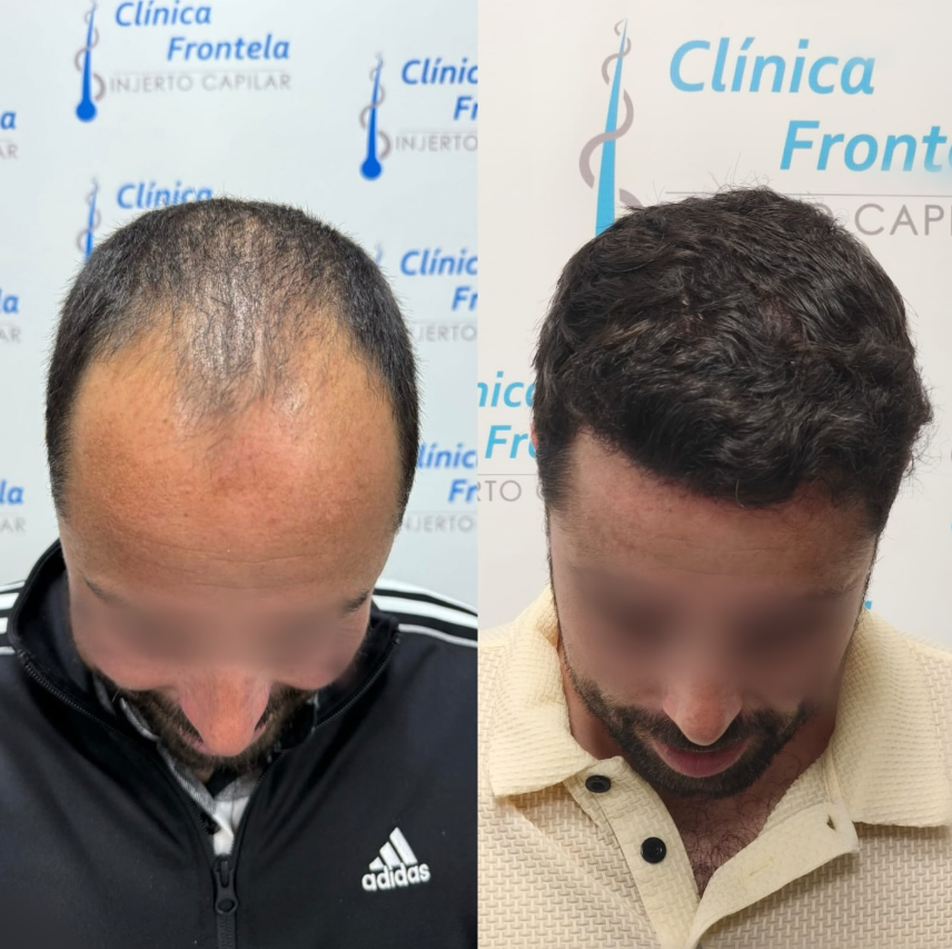Resultado natural de injerto de pelo en paciente con pérdida capilar avanzada.