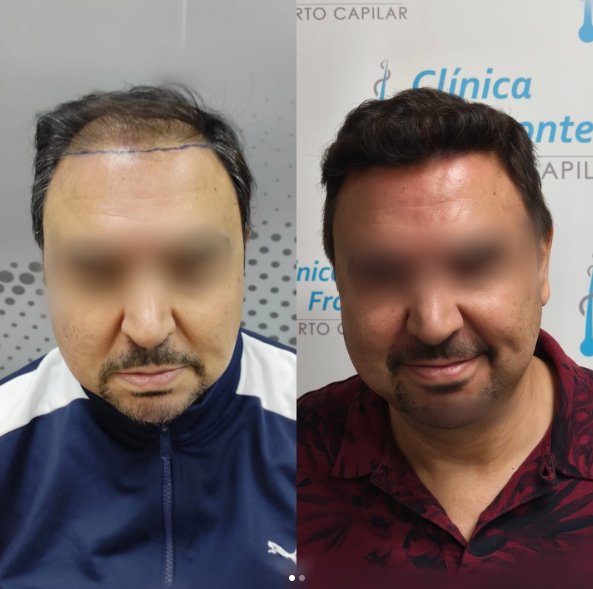 Evolución de paciente tras un injerto capilar con técnica FUE GOLD.