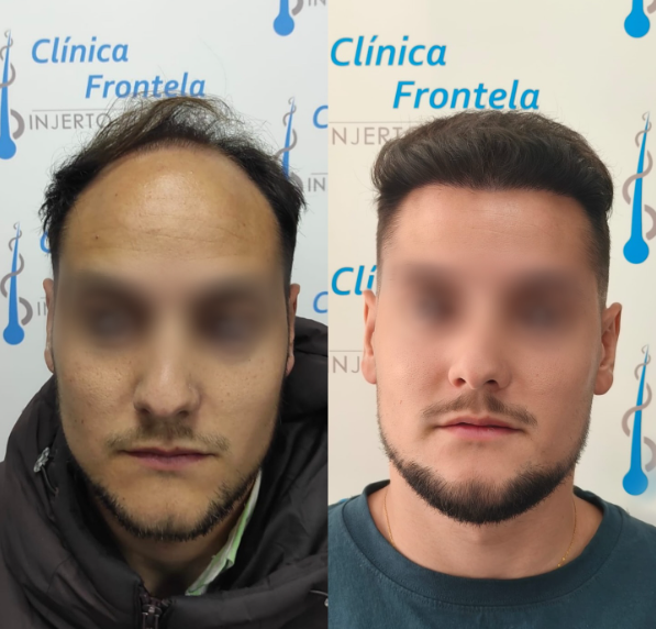Resultado de clínica capilar especializada en injerto de pelo y restauración capilar