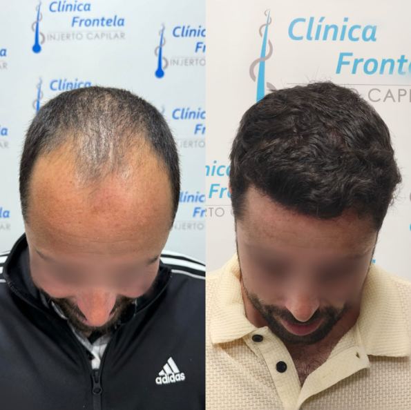 Antes y después de tratamiento de injerto capilar con aspecto natural.