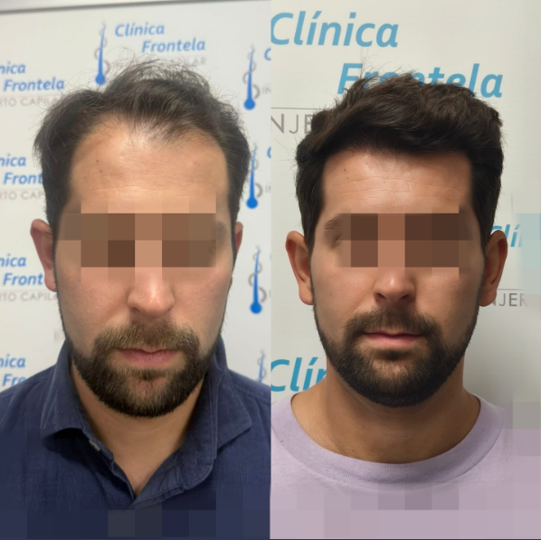 Caso real de injerto de pelo con cobertura de entradas y coronilla.